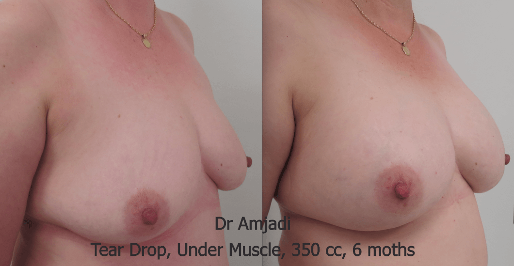 breast implants before after