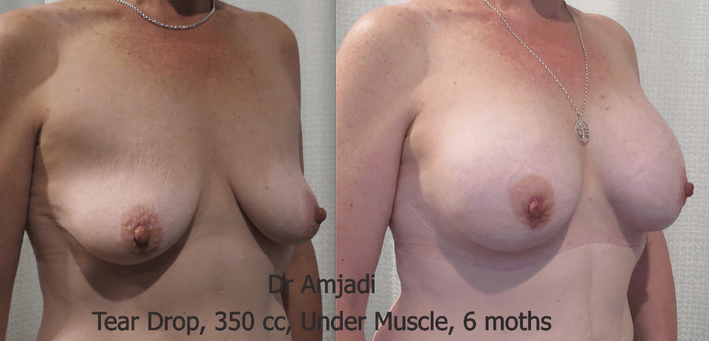 breast implants before after