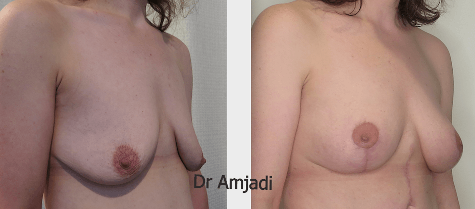 breast lift before after