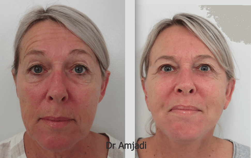 face lift before after