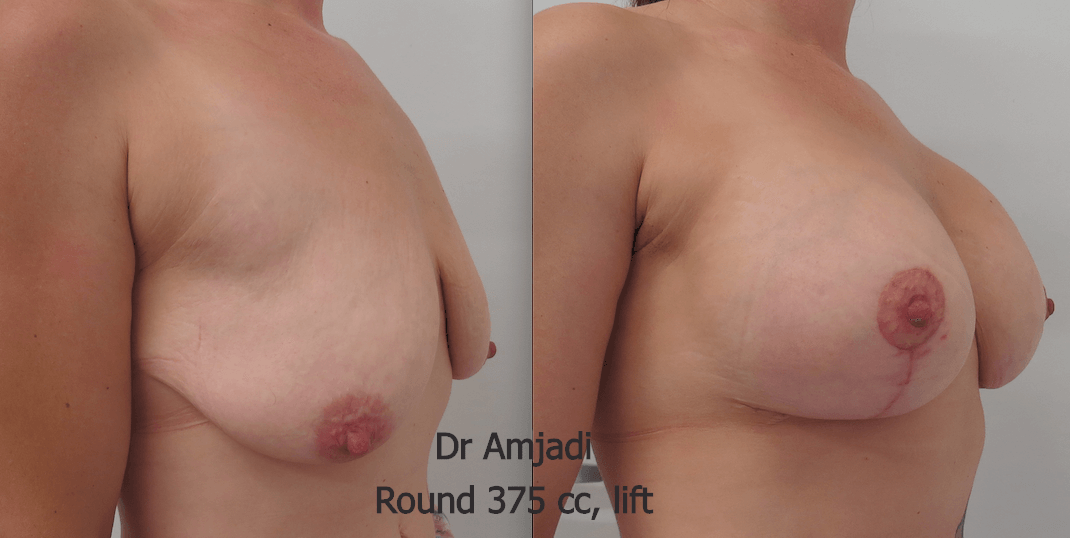 lift with implants before after